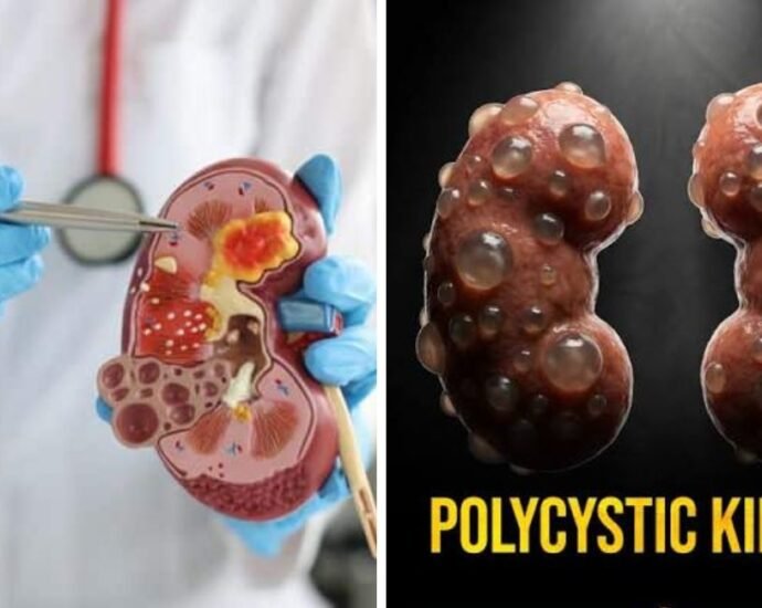 polycystic kidney disease