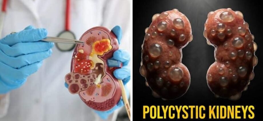 polycystic kidney disease