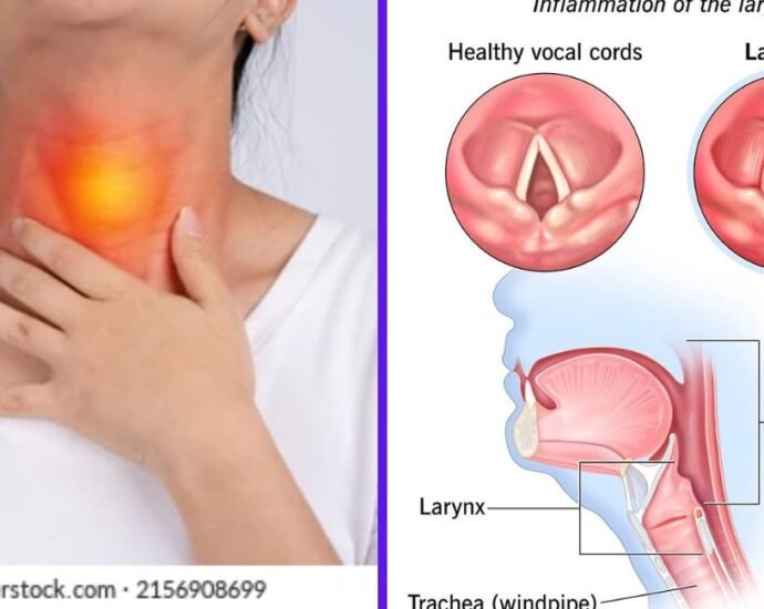 is laryngitis communicable